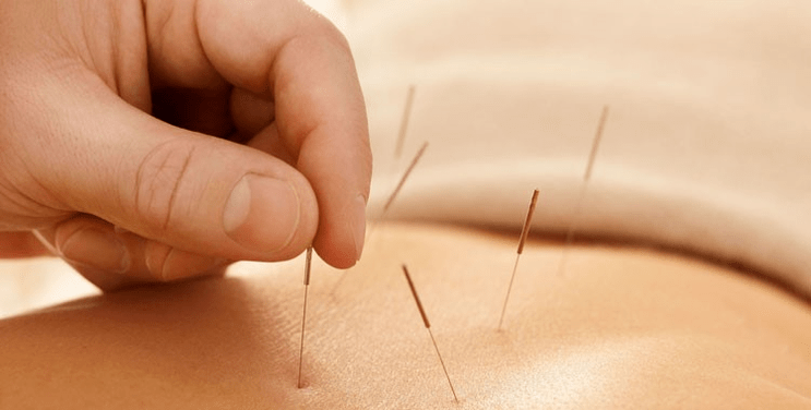 anti-smoking acupuncture